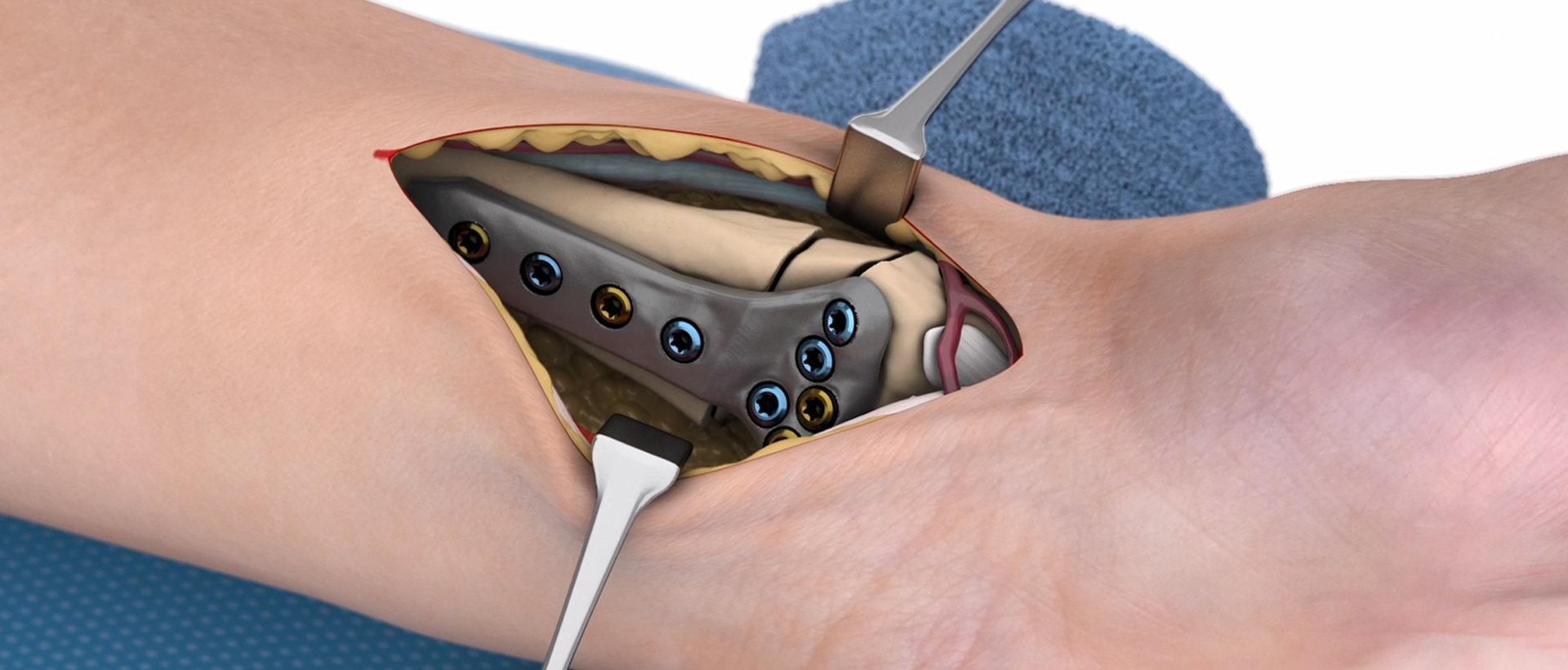 Video | IPS Implants Radius Reconstruction surgical technique